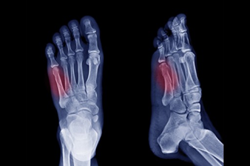 Causes, Symptoms, and Treatment for a Broken Foot