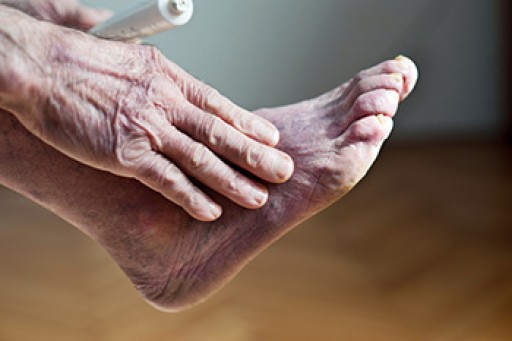 Causes, Symptoms, and Treatment of Poor Blood Circulation in the Feet