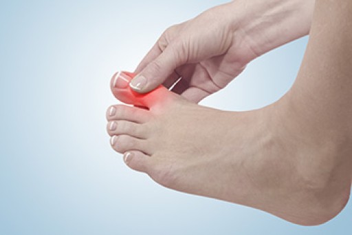 Everything You Need to Know About Gout